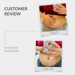 AreoVeda Stretch Marks Remov - view 3