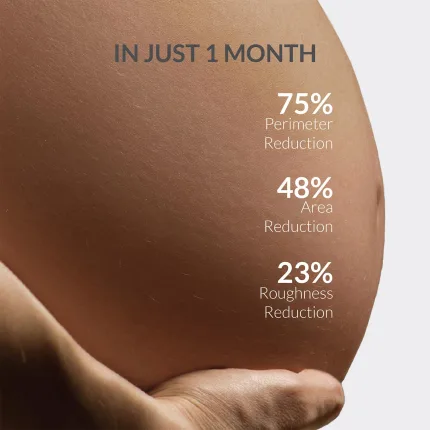 AreoVeda Stretch Marks Remov - view 2