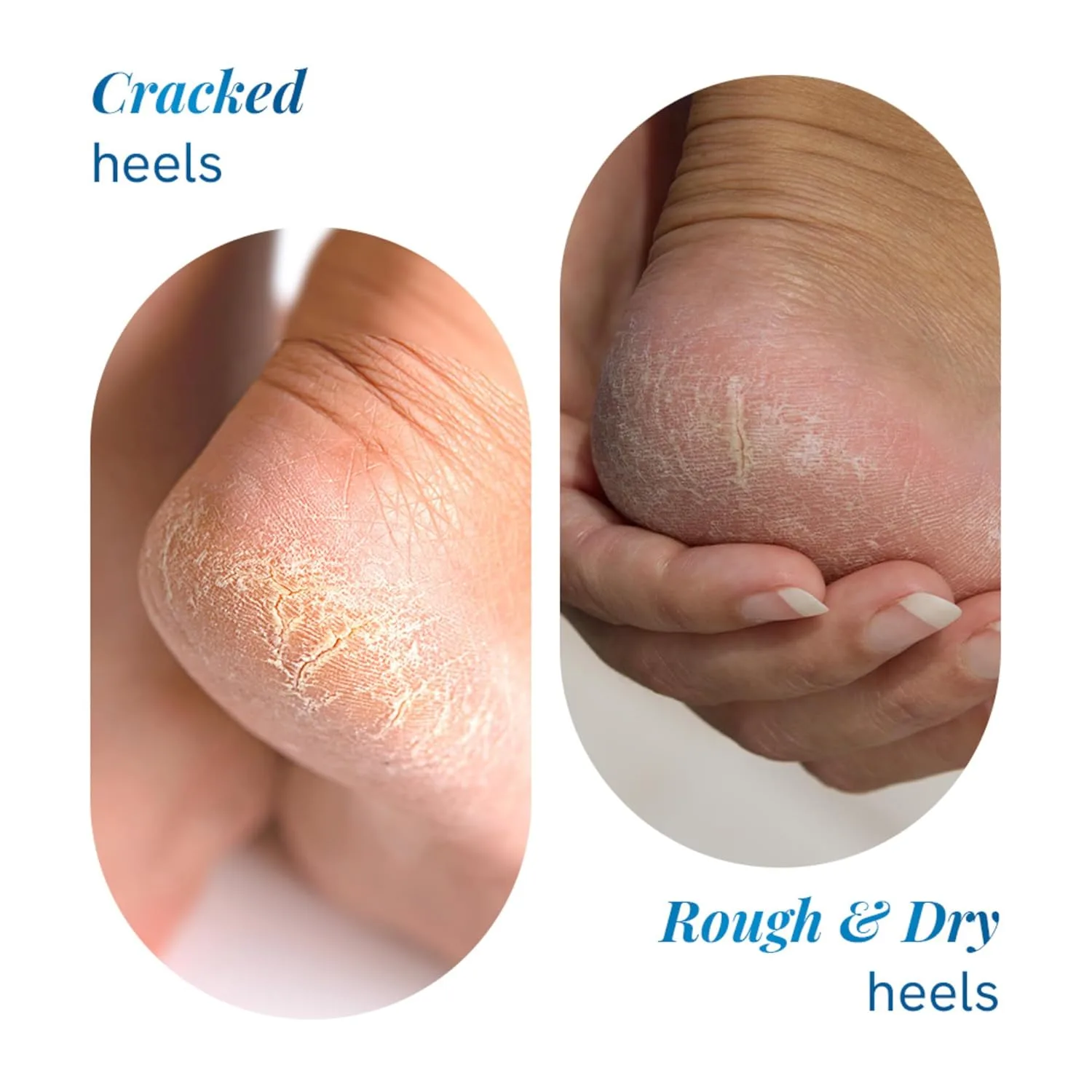 In-Depth Review: best foot cream cracked heels - Be Bodywise 20% Urea Foot Cream Roll On 50ml | For Dry & Cracked Heels | With 2% Lactic Acid, Olive O 5 Be Bodywise 20% Urea F - view 4